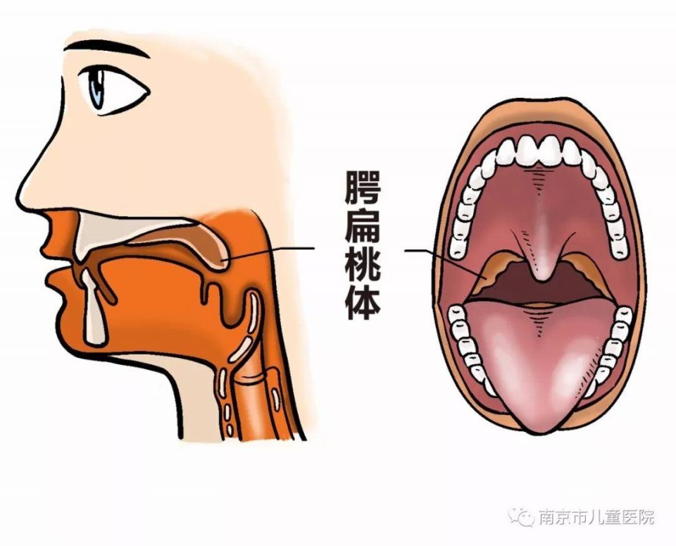 孩子扁桃体老发炎,割还是不割?