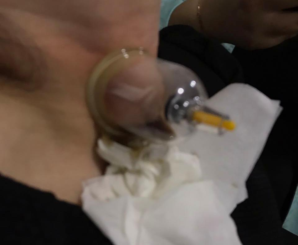 患病先选择保守治疗后效果不佳,在选择手术治疗
