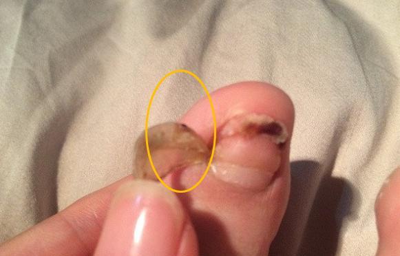 脚指甲长到肉里去了?不要瞎剪,教你一绝招,轻