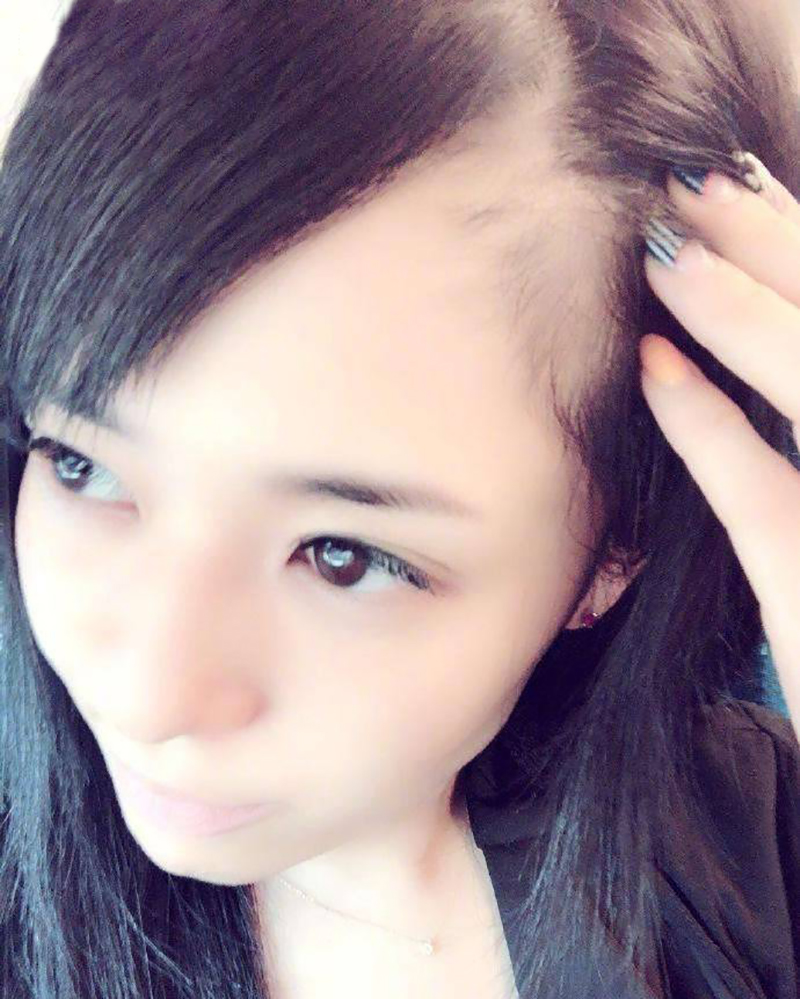 日本前AV女神苍井空脱发严重秃了一大片，原因你都想不到！