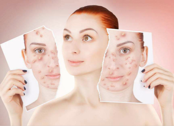 激素脸治疗中为什么还是反反复复过敏又肿又痒