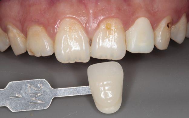 白牙科科普:能做牙齿贴面千万不要做烤瓷牙?