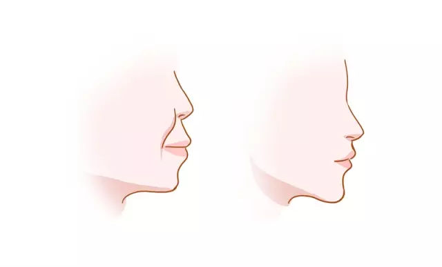 牙科知识科普:牙齿矫正对外貌有多大影响?