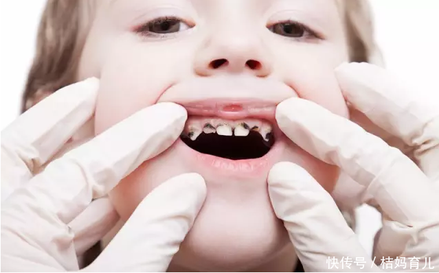 5岁宝宝牙齿全烂光,原来真相在这里,麻麻们再