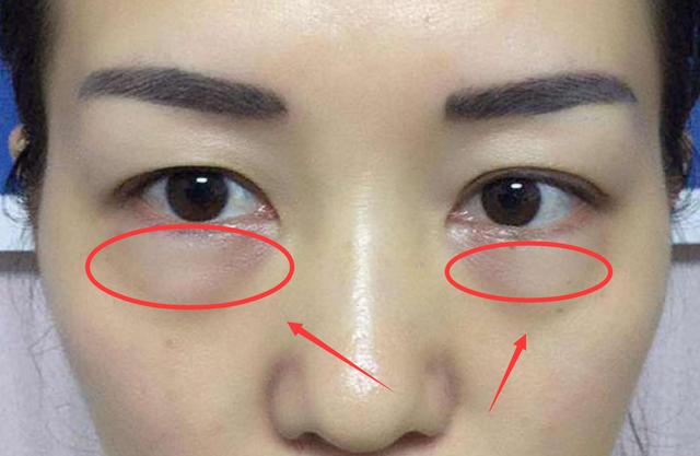 大眼袋难看又显老?教你一招,一条毛巾就能搞定,女士们的福利