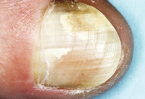 脚趾甲变色是身体发出的健康信号,这10张图教