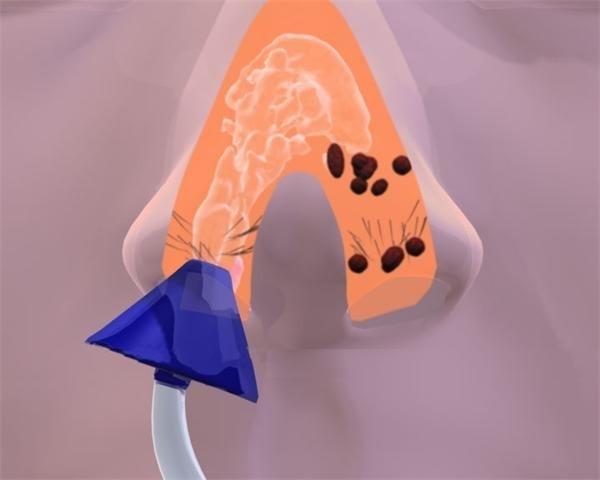 过敏性鼻炎,可以天天用盐水洗鼻子吗?