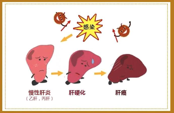 脂肪肝引起谷草高严重吗