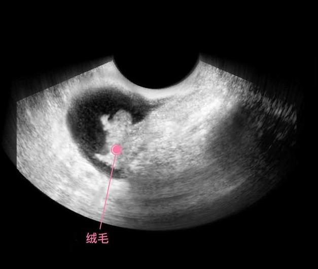 胎儿从卵泡到性别形成,17张图片清晰诠释,男宝