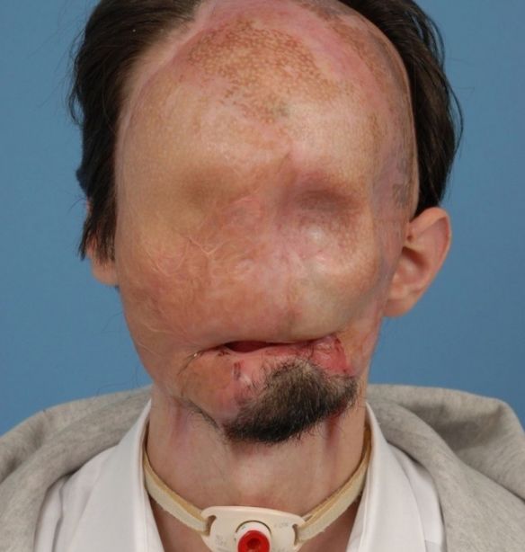 男子车祸后,导致脸部面目全非,吓坏众人,换脸手术让他