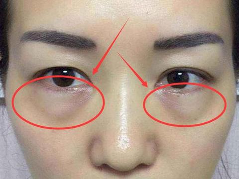 有眼袋显老又显疲,想通过日常美容护理改善,求推荐有效的眼霜或按摩手法?