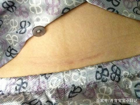 剖腹产刀口多久恢复