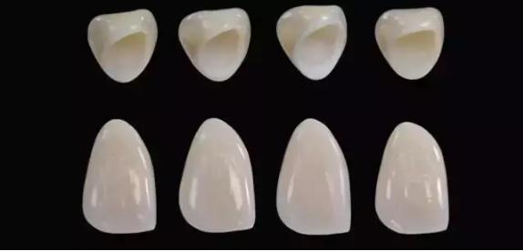 白牙科科普:能做牙齿贴面千万不要做烤瓷牙?