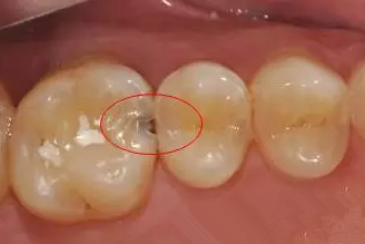 牙缝里那些黑色的东西到底是什么?