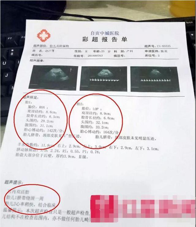 孕妈b超产检为双胞胎分娩却只生下一个医生另一个被吸收了