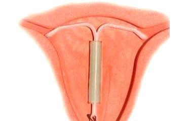 取节育环到底有多痛? 有人说, 这个痛一辈子忘