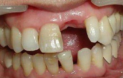 牙齿根部坏了怎么回事? 能治吗?