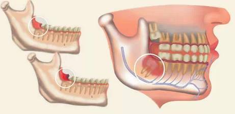 拔智齿会影响脸型吗?不拔智齿都有哪些危害?