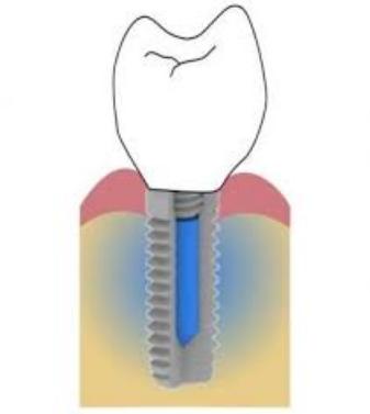 微创拔牙赵医生:种一颗牙要多少钱?