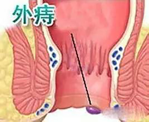 外痔疮的类型有几种你知道吗?痔疮该怎么预防