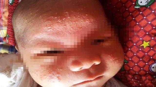 孕妈怀孕后最怕的就是宝宝胎毒,做好2点,跟宝