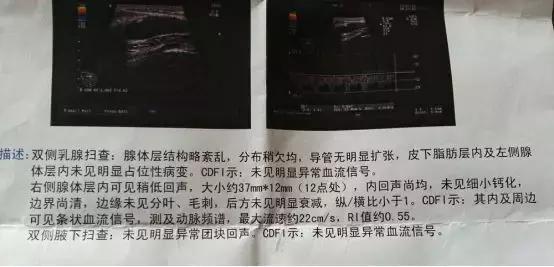 看到乳腺B超报告一头雾水，教你看懂它！
