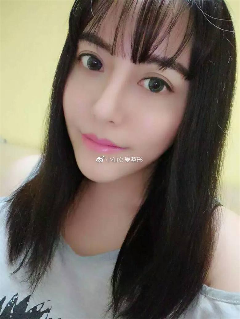 北京种植发际线恢复日记:担心自己被叫成小尼