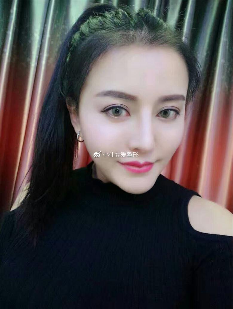 北京种植发际线恢复日记:担心自己被叫成小尼