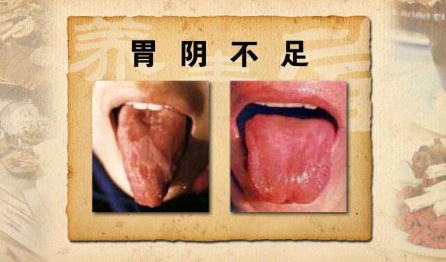 解决宝宝地图舌的最近时机是?地图舌的危害,其