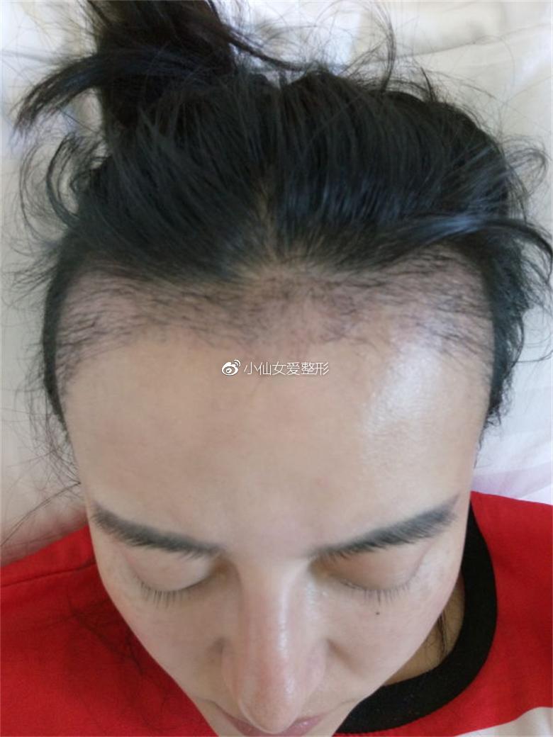 北京种植发际线恢复日记:担心自己被叫成小尼