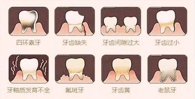 成都爱威白牙科科普知识:牙贴面修复方法及价