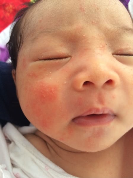 宝宝湿疹反复不好,非常值得看的一篇文章