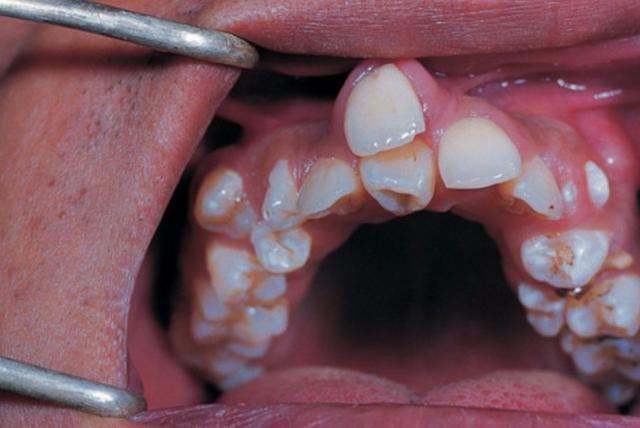 8岁小孩竟长出畸形双排牙,牙医:都是父母的错!