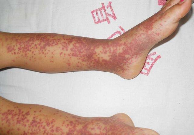 若皮肤出现瘀斑,可能与5种疾病有关,一旦发现,最好去
