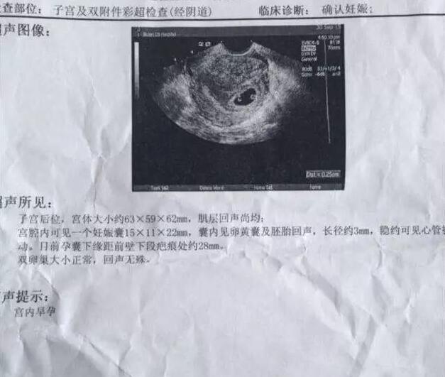 孕囊看男女! 据说很准哦!