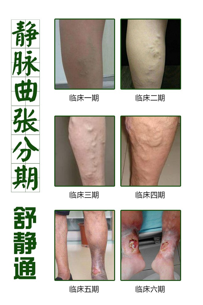 下肢静脉曲张有什么好的治疗方法 生活预防很重要