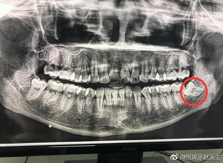 微创拔牙赵医生讲述:拔智齿后谨记4个注意事项