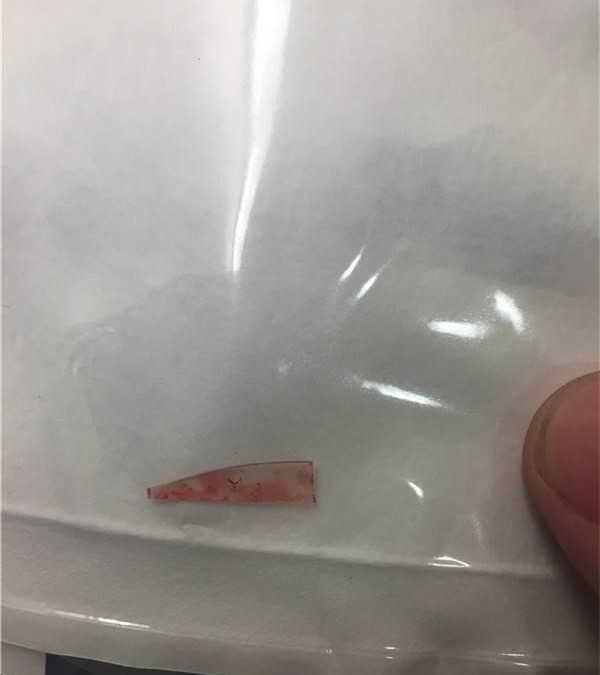 男子胳膊里有硬块, 结果让人出一身汗!