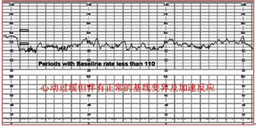 指胎心率基线程度低于110次/分.如下图所示
