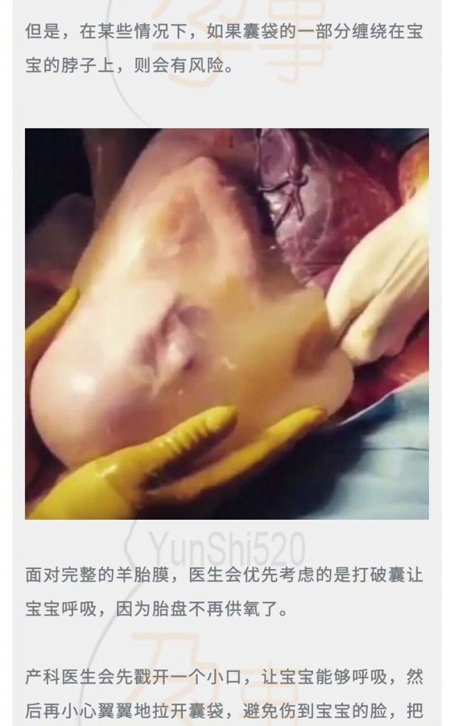 你见过和羊胎膜一起出生的孩子么?医生都惊了!据说这