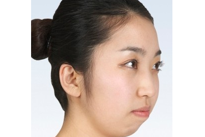 牙套和整形哪个改善下巴后缩自然可靠?