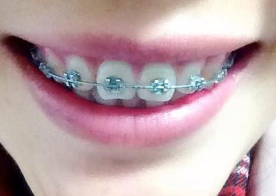 牙套和整形哪个改善下巴后缩自然可靠?