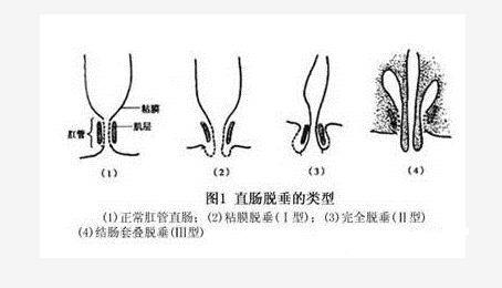襄阳东大肛肠医院:抹了几年痔疮膏,检查却是脱