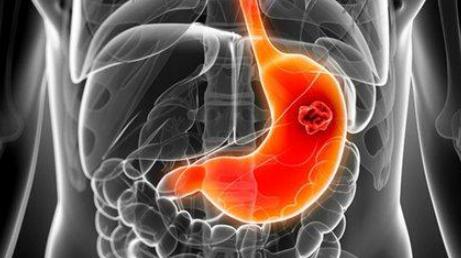 胃病都是幽门螺杆菌惹的祸,一旦出现七种症状