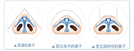 蒜头鼻整形了解吗?前后对比照片效果图