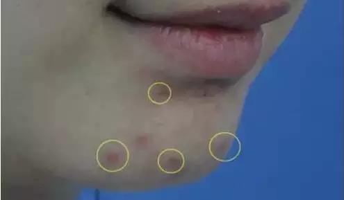 脸上能够挤出黄颗粒,这是毛囊虫的信号!要小心