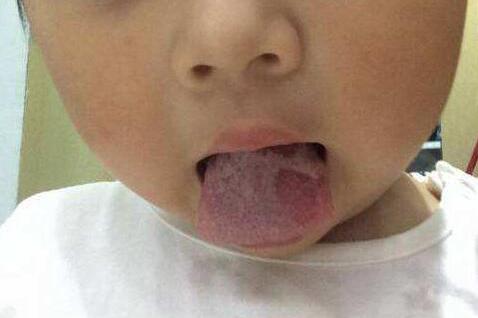 解决宝宝地图舌的最近时机是?地图舌的危害,其