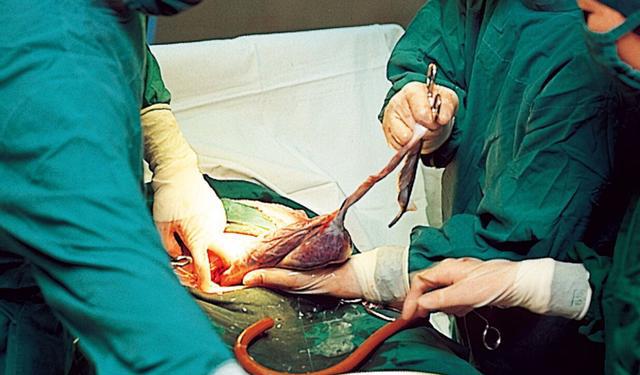 缝合子宫的切开部位,将子宫放回原来的位置,将腹壁层层缝合.