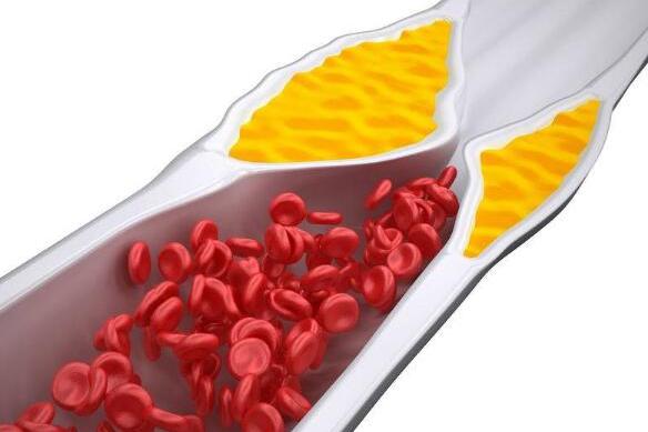 它们是血管“天然支架”，软化血管还不贵!