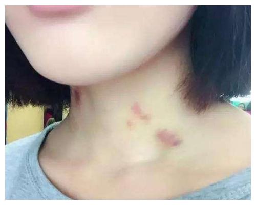 10岁女孩脖子现"草莓印",一顿追问后,女儿的回答让妈妈哭了